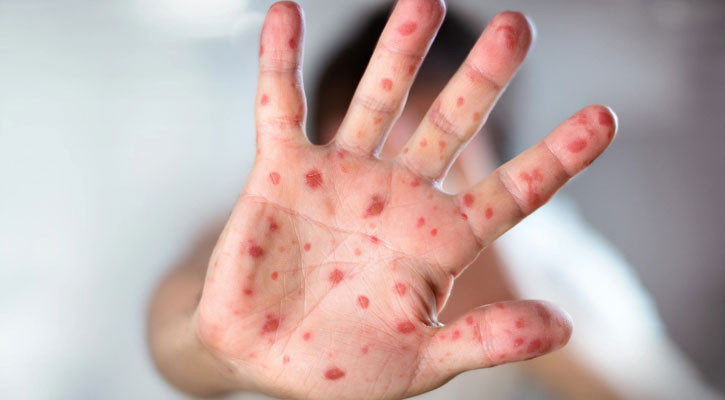 Measles kills 7 more in 24 hours, death toll reaches 488