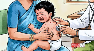 4 more suspected measles deaths in 24hrs, toll rises to 609